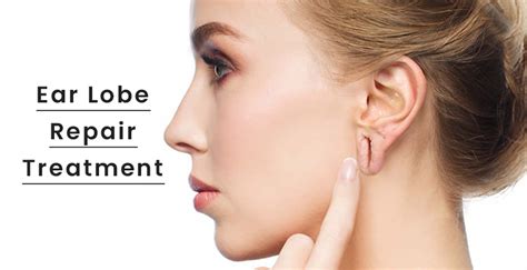 Ear lobe repair in Ahmedabad, Earlobe Repair Treatment | iVA Skin ...