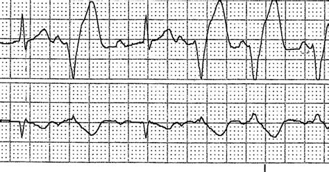 ECG Rhythms: Isorhythmic AV dissociation: SR + VT