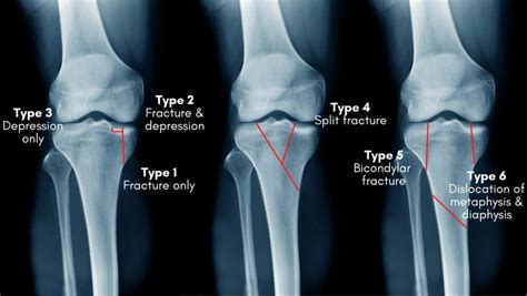 Tibial Plateau Fracture Classification and Treatment