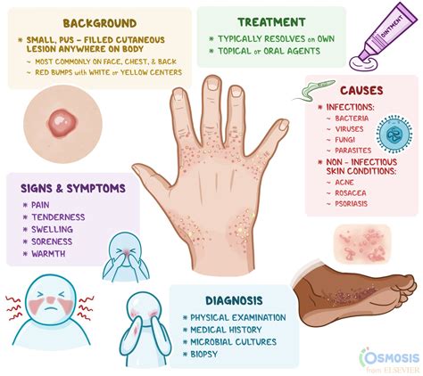 Acne Papules Treatment