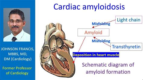 Utility Of Biomarkers In Cardiac Amyloidosis ScienceDirect, 56% OFF