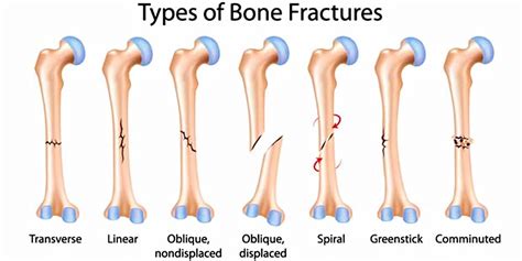 Long bone anatomy, structure, parts, function and fracture types