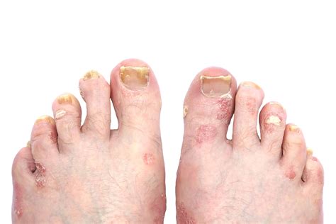 Psoriasis and Psoriatic Arthritis of the Toe Nails and Feet | A Step ...