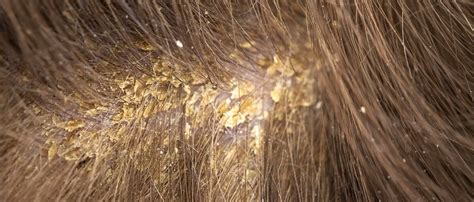 What Are The Good Ways To Cure Scalp Fungus? | CLOCIP - Cipla