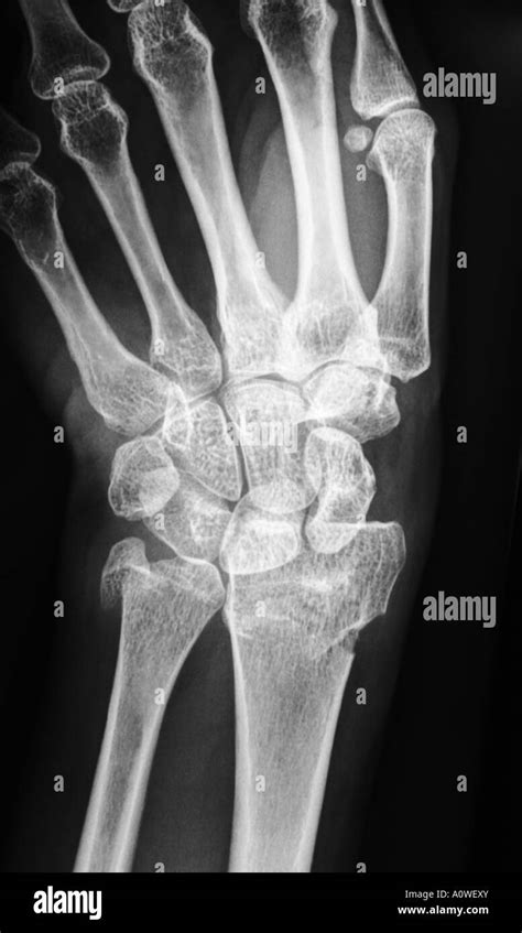 X Ray of human hand with broken wrist, fracture of radius, xray ...