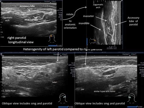 Parotid Gland Duct Ultrasound