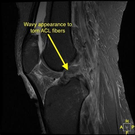 Mri Knee Acl Tear