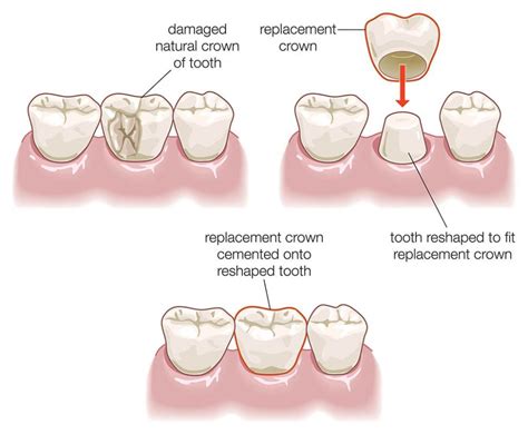 Dental Crowns | Dental Esthetics Center