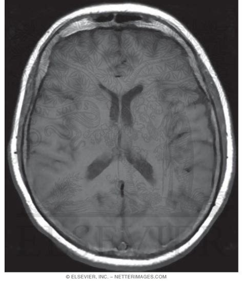 Mri Brain Ventricle Anatomy