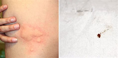 How to Identify and Stop Bed Bug Bites | Debedbug