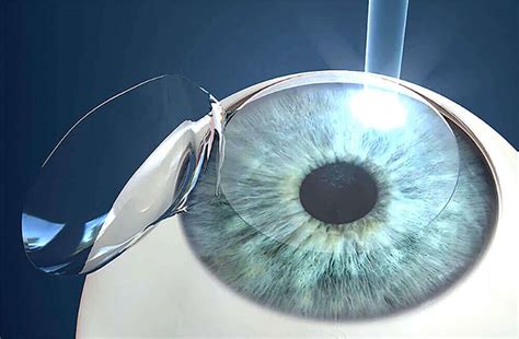 LASIK Center in Boston MA | Laser Vision Correction | Boston Laser