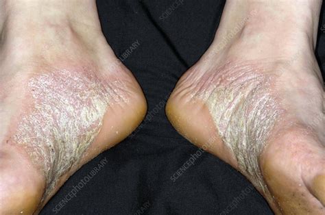 Acute psoriasis on the feet - Stock Image - C004/2473 - Science Photo ...