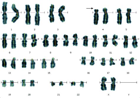 Cytogenetically visible deletion of chromosome 4p in patient 2 ...