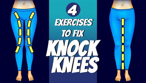 Exercise To Fix Knock Knees - HTV