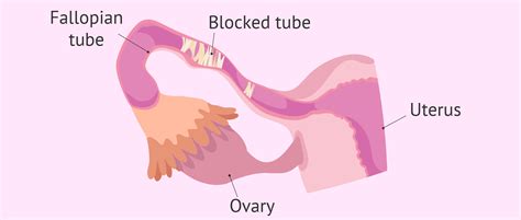 Fallopian tube blockage: is pregnancy still possible?