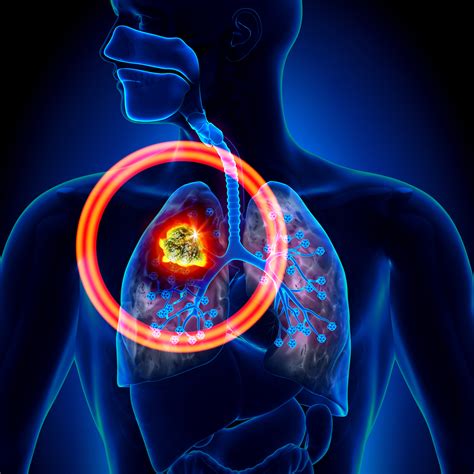 Researchers Recommend Additional PET/CT Scans in Lung Cancer Follow Up