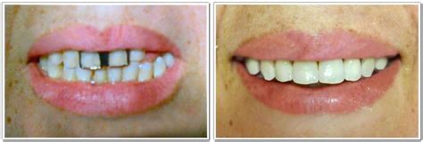 Porcelain Crowns in Woodbury, Long Island | Kate Brayman DDS