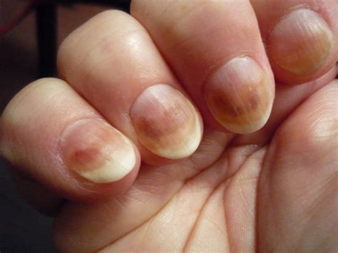 What Do Your Nails Say About Your Health? – Diet Sage