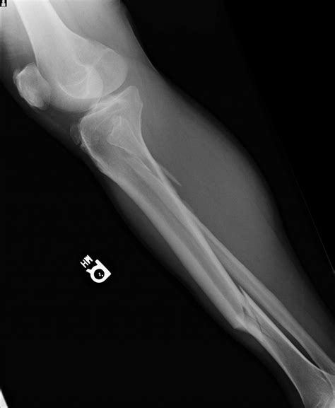 Broken Leg 2nd X-Ray : Biological Science Picture Directory – Pulpbits.net