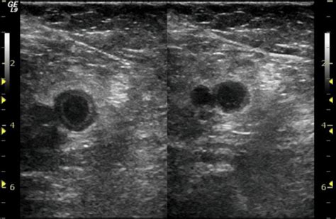 Venous Ultrasound: Indications and Brief Ultrasound Protocol