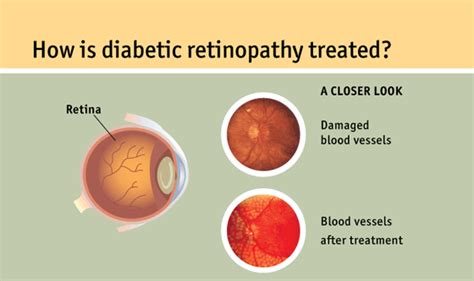 Retinopathy and Retinal detachment | Best eye diseases doctors In Iran