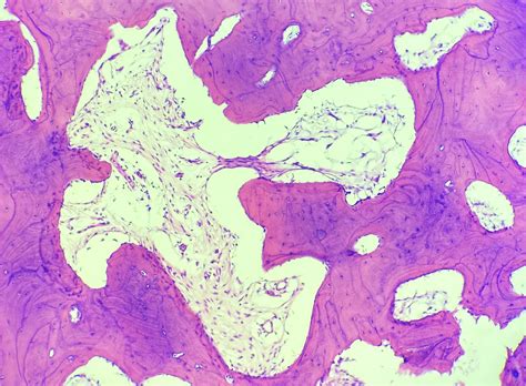 Torus Mandibularis Histology