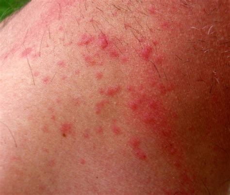 Brown Tail Moth Rash Pictures | Medical Pictures and Images - (2023 ...