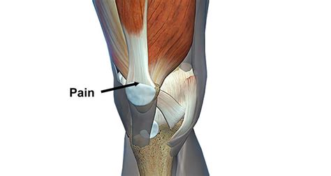 Quadriceps Tendonitis (Tendinopathy) - Sportsinjuryclinic.net