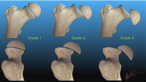 Slipped Capital Femoral Epiphysis | UW Emergency Radiology