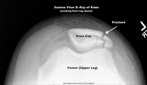 Why is Kyrie Irving's Knee Still Giving Him Problems?