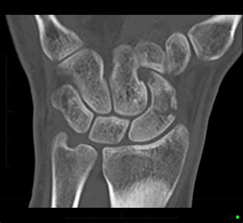 MRI for Hand and Wrist Injuries - Melbourne Radiology