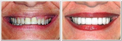 Porcelain Crowns in Woodbury, Long Island | Kate Brayman DDS