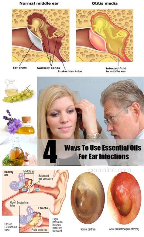 Home Remedies for Ear Infection | Ear infection home remedies, Home ...