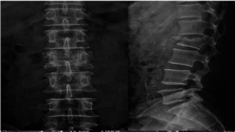 Lumbar Vertebrae X Ray