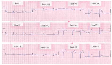 Lead Surface Electrocardiogram Ecg Of Typical Atrial Flutter | The Best ...