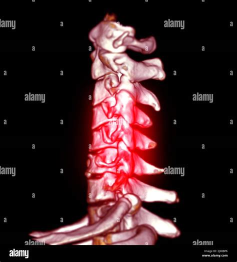 CT SCAN of Cervical Spine ( C-spine ) patient trauma case 3D rendering ...