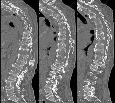 Secondary spinal cancer, CT scans - Stock Image - C021/2288 - Science ...