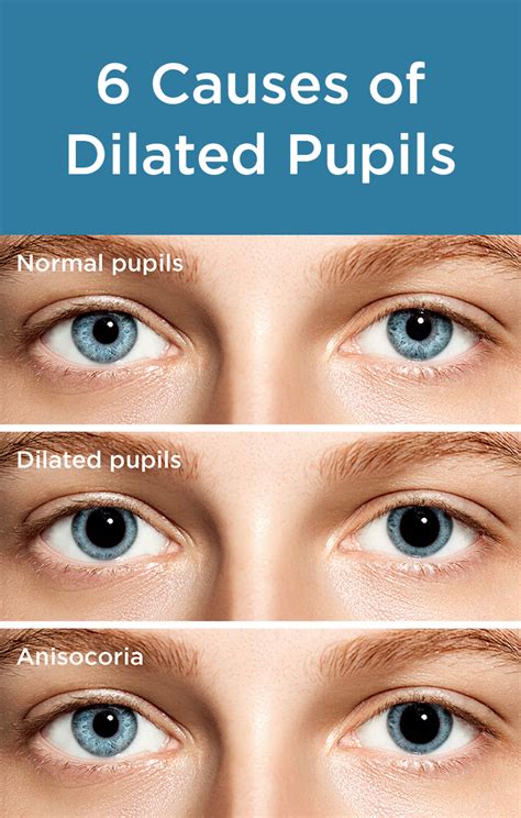 Dilated Pupils: Causes and Concerns | Dilated pupils, Eye health, Eye facts