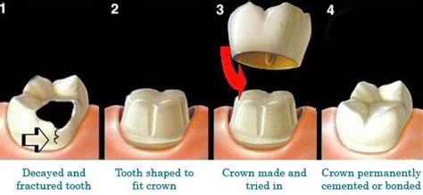 Omni Dental Group: Crowns: An Overview