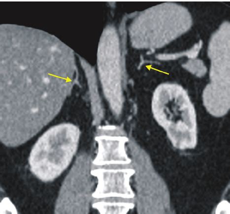 Adrenal Gland Ct Scan