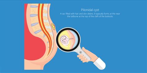 Pilonidal Cyst With Hair