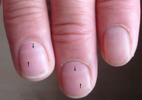 Fingernails changes associated with chemotherapy in breast cancer ...