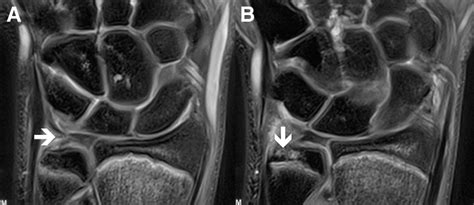 (A) MRI study showing a tear (arrow) in the ulnar portion of the TFCC ...