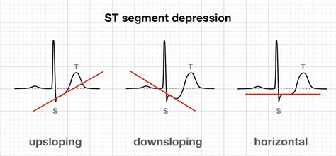 The ST Segment • LITFL • ECG Library Basics