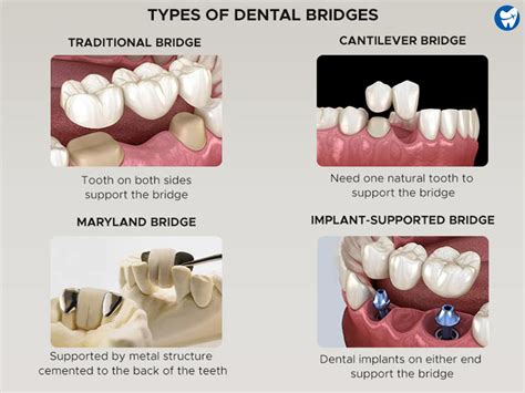 Dental Crowns: Cost (With-Without Insurance), Types, Procedure, Benefits