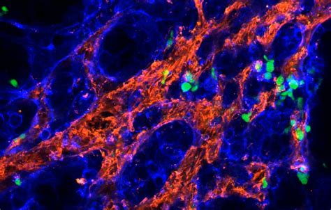 Gamma delta T cells can fight aggressive breast cancer