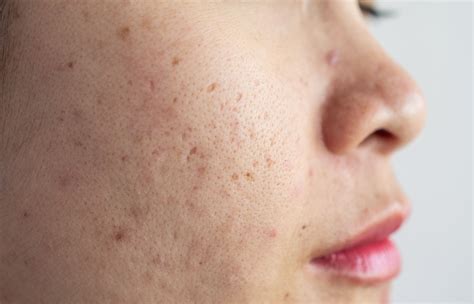 Ask a Dermatologist: How to Get Rid of Pitted Acne Scars