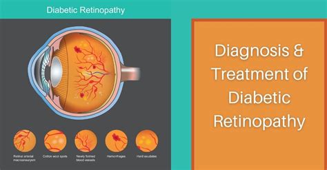 Diagnosis and Treatment of Diabetic Retinopathy