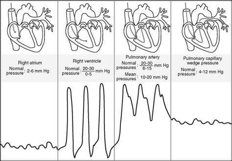 Right Heart Cath Pressure Waveforms