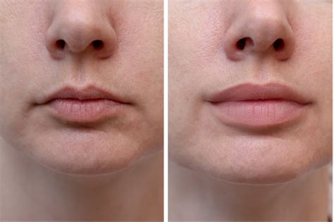 Filler in the Lips - Vedas Medical Spa and Wellness Center